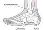 Achilles Tendonitis Flat Feet | Boynerclinic.com